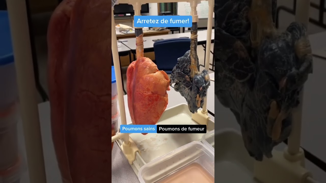 Tu fumes? Ben voila pourquoi arreter…#tabac #fumer #cancer #medecine #health #medical #santé